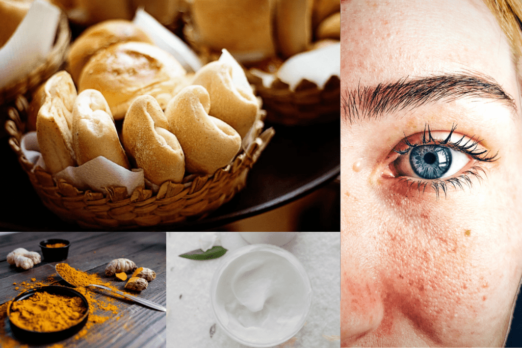 50 Natural Home Remedies Treatment For Fungal Skin Infections (2)